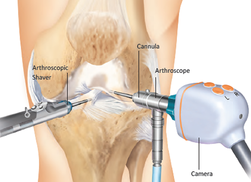 Knee Arthroscopy Diagram